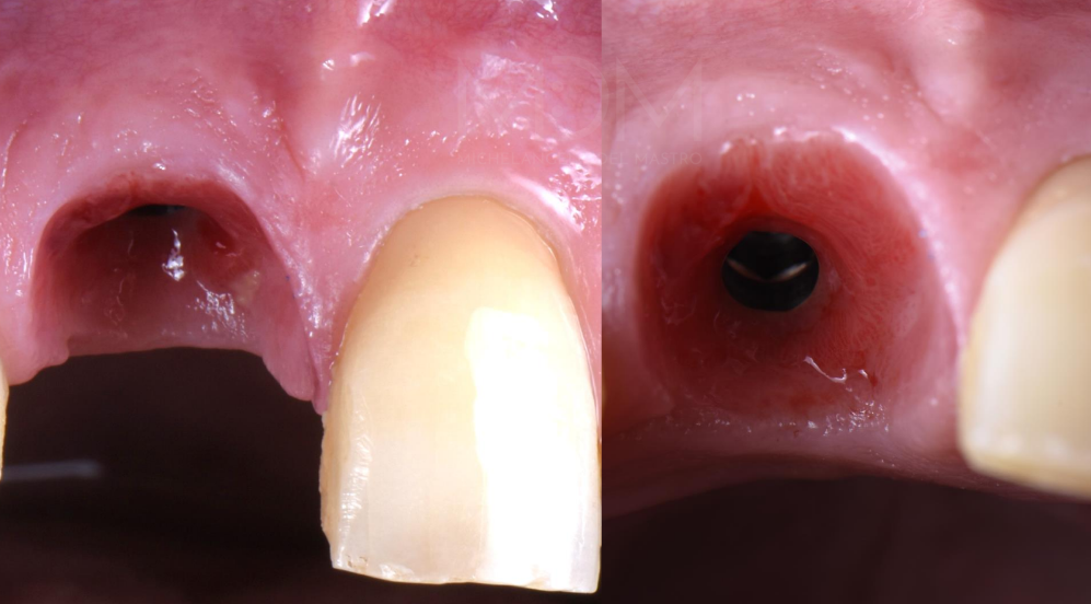 Curso zona estética periimplantaria