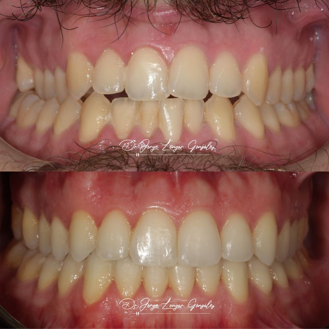 Mastering Aligner Biomechanics - Modular Ortodoncia