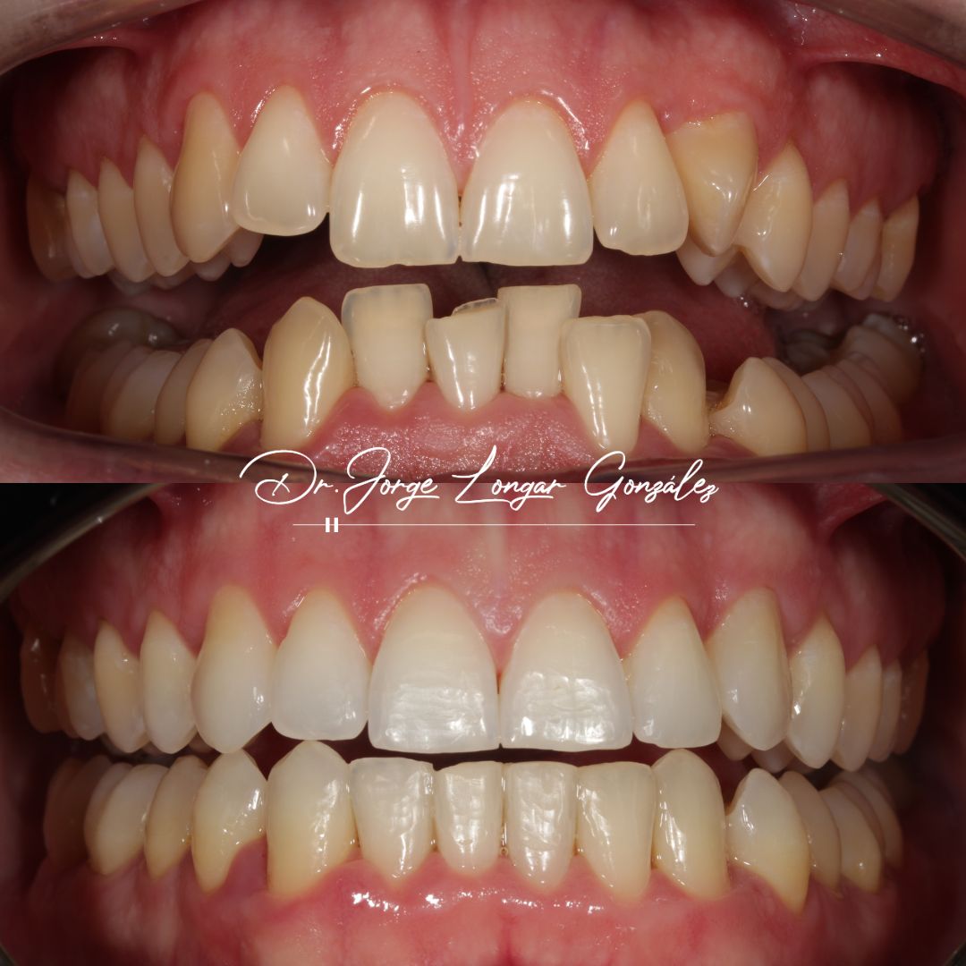 Mastering Aligner Biomechanics - Modular Ortodoncia