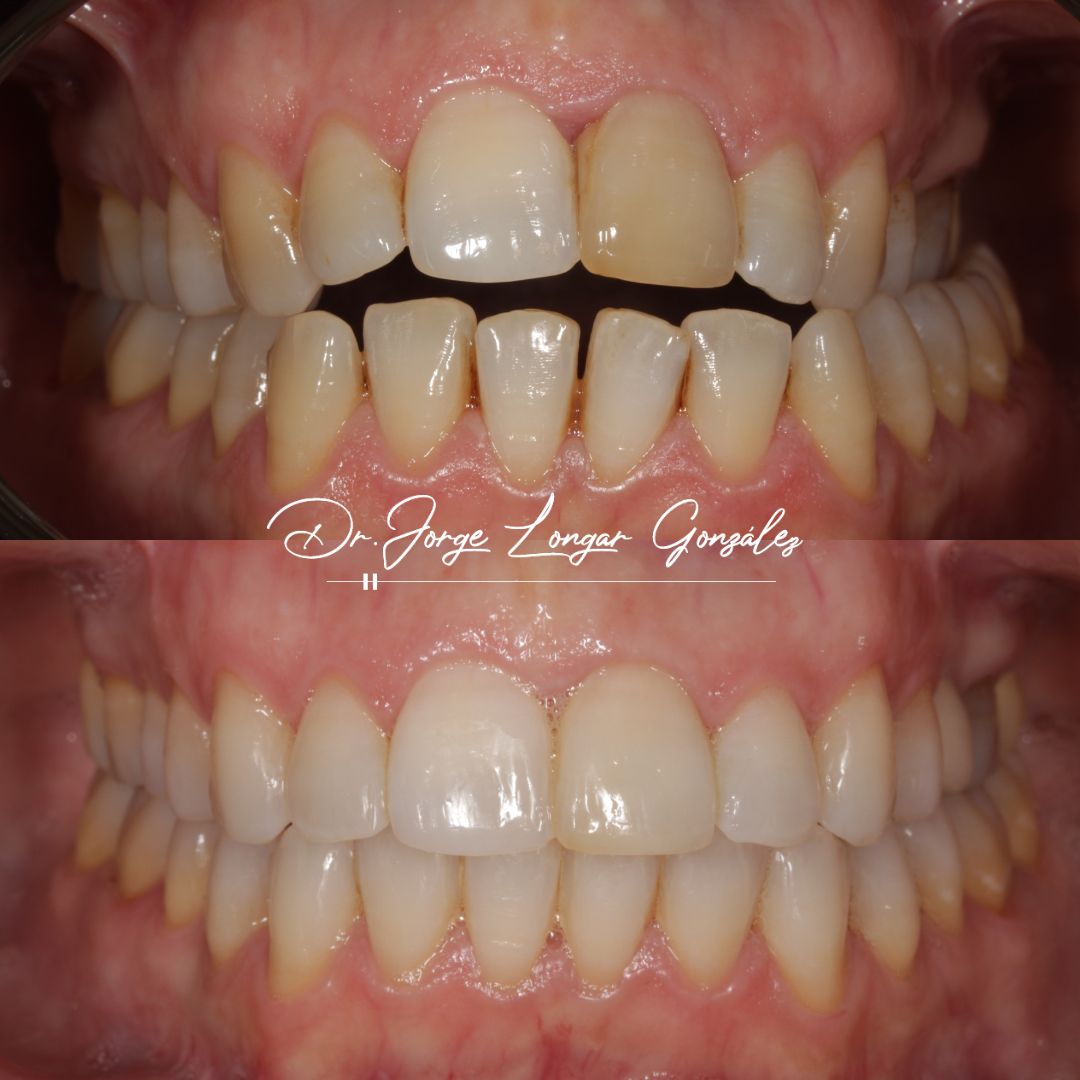 Mastering Aligner Biomechanics - Modular Ortodoncia