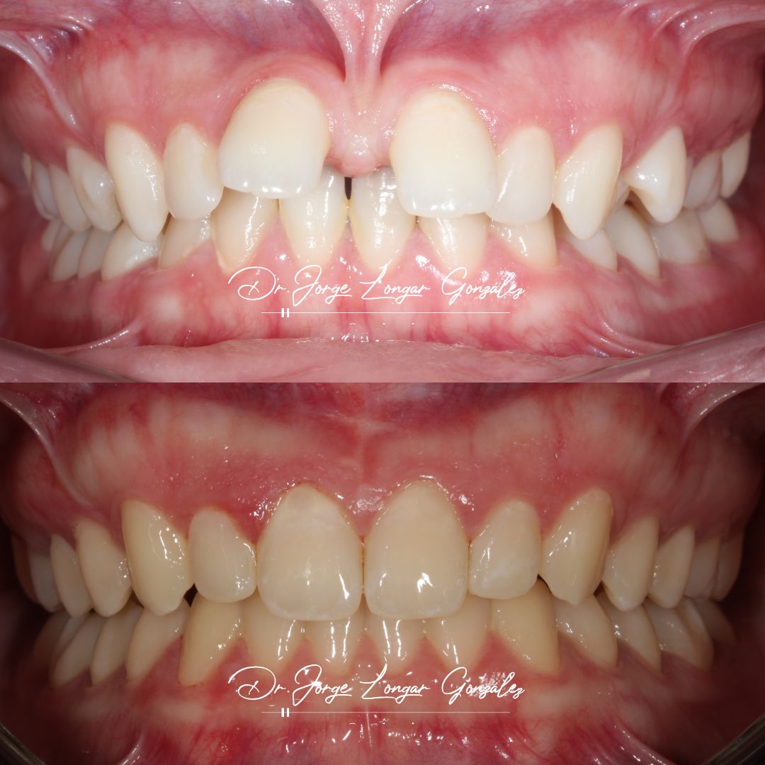 Mastering Aligner Biomechanics - Modular Ortodoncia