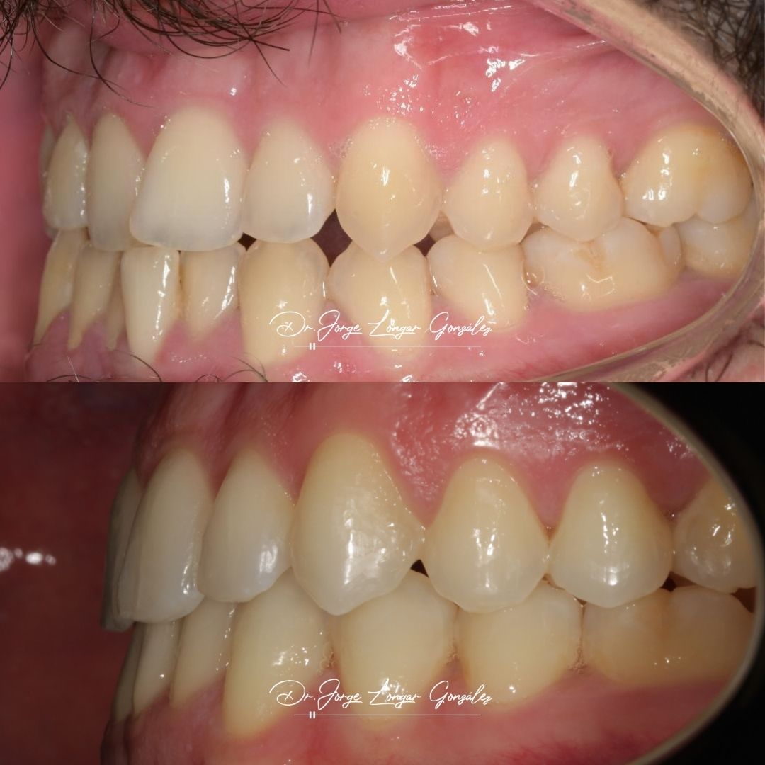 Mastering Aligner Biomechanics - Modular Ortodoncia