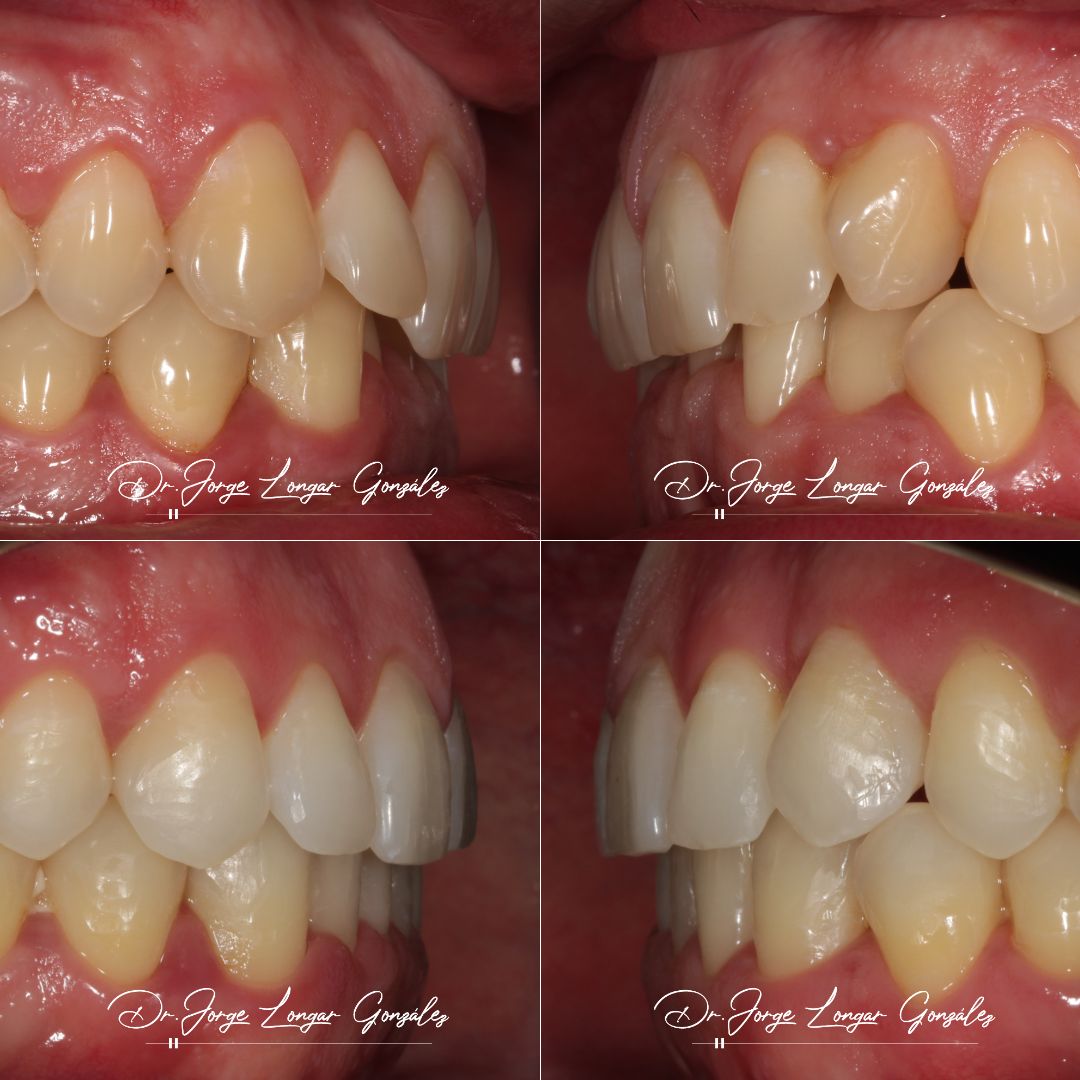 Mastering Aligner Biomechanics - Modular Ortodoncia