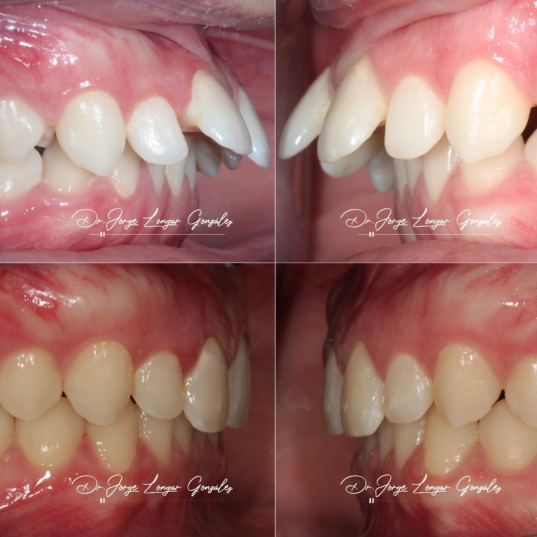 Mastering Aligner Biomechanics - Modular Ortodoncia