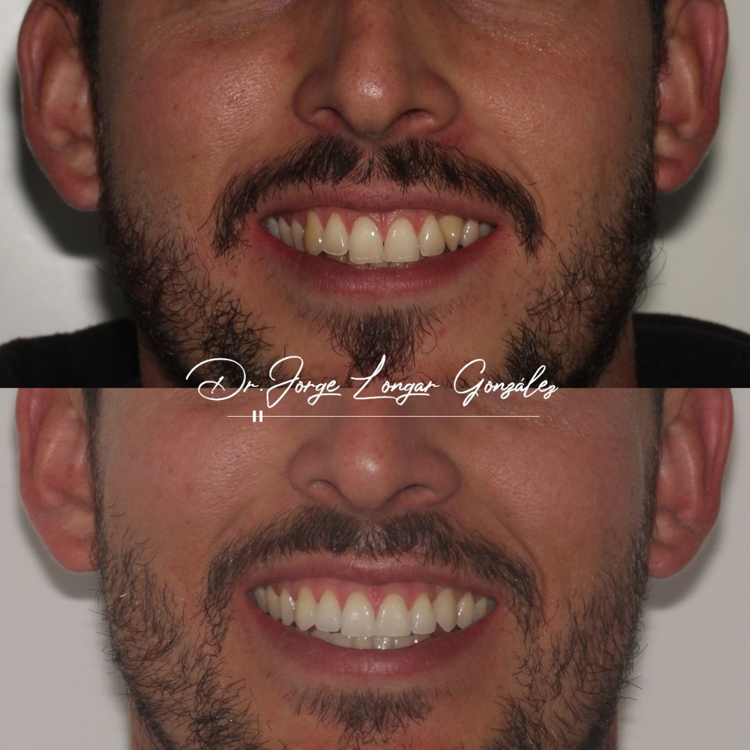 Mastering Aligner Biomechanics - Modular Ortodoncia