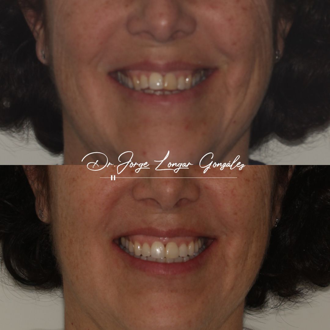 Mastering Aligner Biomechanics - Modular Ortodoncia