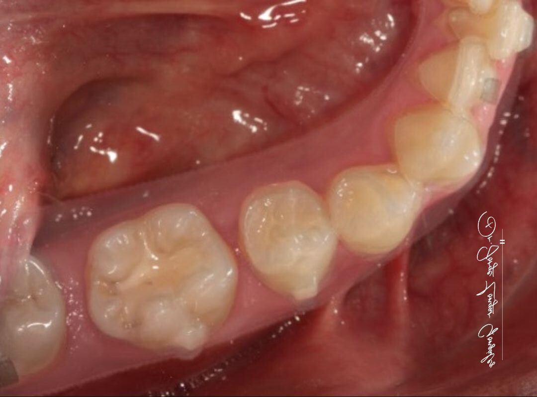 Mastering Aligner Biomechanics - Modular Ortodoncia