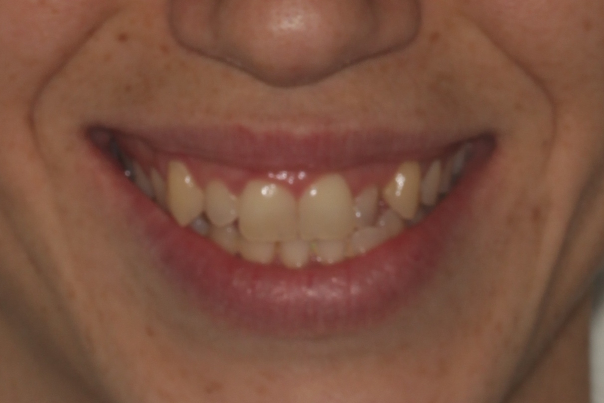 Mastering Aligner Biomechanics - Modular Ortodoncia