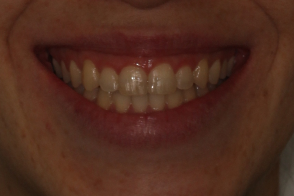 Mastering Aligner Biomechanics - Modular Ortodoncia