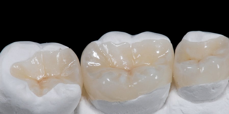 caso-de-incrustacion-dental