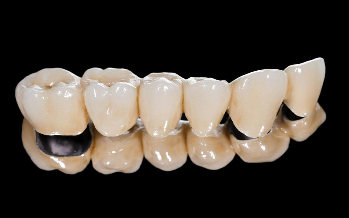 metal-ceramica